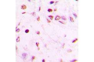 Immunohistochemical analysis of GATA4 staining in human lung cancer formalin fixed paraffin embedded tissue section. (GATA4 抗体  (Center))