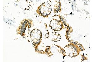 ABIN6258437 and ABIN6274598 at 1/100 staining Human colorectal cancer by IHC-P. (LI Cadherin 抗体  (Internal Region))