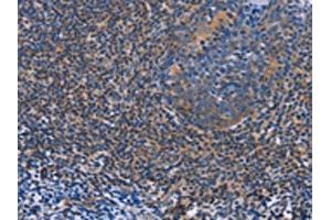 The image on the left is immunohistochemistry of paraffin-embedded Human tonsil tissue using ABIN7128290(AGFG1 Antibody) at dilution 1/60, on the right is treated with fusion protein. (AGFG1 抗体)