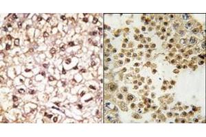 (LEFT)Formalin-fixed and paraffin-embedded human cancer tissue reacted with the primary antibody, which was peroxidase-conjugated to the secondary antibody, followed by AEC staining. (Parkin 抗体  (N-Term))