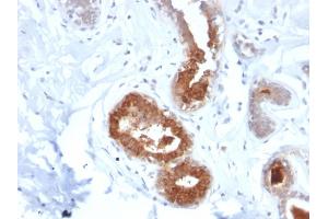 Formalin-fixed, paraffin-embedded human Breast Carcinoma stained with Mammaglobin Recombinant Rabbit Monoclonal Antibody (MGB1/2123R). (Recombinant Mammaglobin A 抗体)