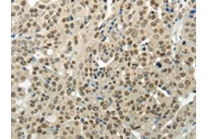 The image on the left is immunohistochemistry of paraffin-embedded Human breast cancer tissue using ABIN7189956(BAZ1B Antibody) at dilution 1/35, on the right is treated with synthetic peptide. (BAZ1B 抗体)
