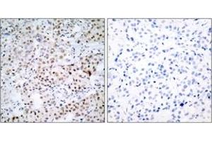 Immunohistochemistry analysis of paraffin-embedded human breast carcinoma tissue, using CREB (Ab-133) Antibody. (CREB1 抗体  (AA 100-149))
