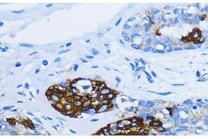Immunohistochemistry of paraffin-embedded Human mammary cancer using EEA1 Polyclonal Antibody at dilution of 1:100 (40x lens). (EEA1 抗体)