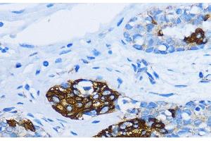 Immunohistochemistry of paraffin-embedded Human mammary cancer using EEA1 Polyclonal Antibody at dilution of 1:100 (40x lens). (EEA1 抗体)