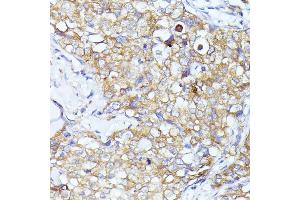 Immunohistochemistry of paraffin-embedded human mammary cancer using EIF3L antibody (ABIN6131772, ABIN6140074, ABIN6140075 and ABIN6225315) at dilution of 1:100 (40x lens). (EIF3L 抗体  (AA 1-230))