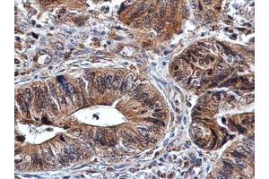 IHC-P Image Amphiregulin antibody detects Amphiregulin protein at cytoplasm in human colon cancer by immunohistochemical analysis. (Amphiregulin 抗体)