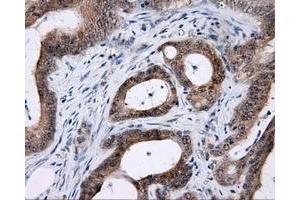 Immunohistochemical staining of paraffin-embedded Carcinoma of prostate tissue using anti-LIPG mouse monoclonal antibody. (LIPG 抗体)