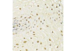 Immunohistochemistry of paraffin-embedded human esophageal cancer using HDAC3 Antibody. (HDAC3 抗体  (AA 299-428))