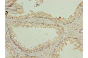 Immunohistochemistry of paraffin-embedded human prostate cancer using ABIN7161122 at dilution of 1:100 (N4BP2L2 抗体  (AA 1-300))