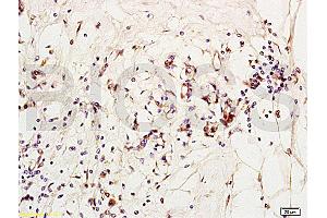Formalin-fixed and paraffin embedded human breast carcinoma labeled with Anti-MCP-2 Polyclonal Antibody, Unconjugated (ABIN676283) at 1:200 followed by conjugation to the secondary antibody and DAB staining