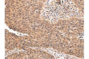 The image on the left is immunohistochemistry of paraffin-embedded Human lung cancer tissue using ABIN7193106(ZNF146 Antibody) at dilution 1/20, on the right is treated with synthetic peptide.