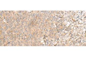Immunohistochemistry of paraffin-embedded Human ovarian cancer tissue using RNF207 Polyclonal Antibody at dilution of 1:40(x200) (RNF207 抗体)