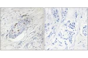 Immunohistochemistry analysis of paraffin-embedded human breast carcinoma, using ZNF232 Antibody. (ZNF232 抗体  (AA 171-220))