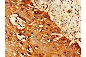 Immunohistochemistry of paraffin-embedded human cervical cancer using ABIN7164944 at dilution of 1:100 (PSMA1 抗体  (AA 163-263))