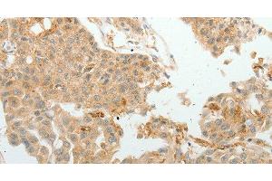 Immunohistochemistry of paraffin-embedded Human lung cancer tissue using ASCL1 Polyclonal Antibody at dilution 1:30 (ASCL1 抗体)