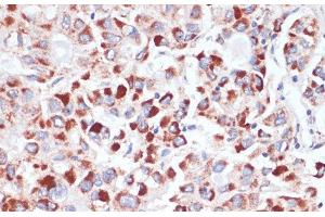 Immunohistochemistry of paraffin-embedded Human liver cancer using TFRC Polyclonal Antibody at dilution of 1:100 (40x lens). (Transferrin Receptor 抗体)