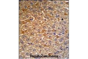HRG Antibody (N-term) (R) IHC analysis in formalin fixed and paraffin embedded human hepatocarcinoma tissue followed by peroxidase conjugation of the secondary antibody and DAB staining. (HRG 抗体  (N-Term))