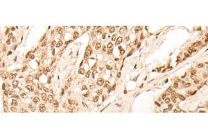 Immunohistochemistry of paraffin-embedded Human breast cancer tissue using EIF4A3 Polyclonal Antibody at dilution of 1:45(x200) (EIF4A3 抗体)