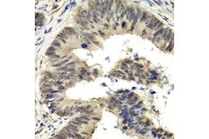Immunohistochemistry of paraffin-embedded human colon carcinoma using NELFE antibody at dilution of 1:100 (x40 lens). (RDBP 抗体)