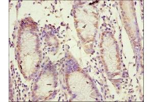 Immunohistochemistry of paraffin-embedded human gastric cancer using ABIN7170849 at dilution of 1:100