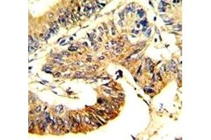 IHC analysis of FFPE human colon carcinoma stained with ASS1 antibody (ASS1 抗体  (AA 192-221))