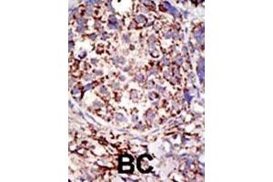 Formalin-fixed and paraffin-embedded human cancer tissue reacted with the primary antibody, which was peroxidase-conjugated to the secondary antibody, followed by DAB staining. (USP3 抗体  (C-Term))