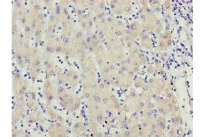 Immunohistochemistry of paraffin-embedded human liver cancer using ABIN7159626 at dilution of 1:100 (MCCC2 抗体  (AA 284-563))