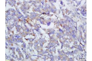 Formalin-fixed and paraffin embedded human lung cancer labeled with Anti-Complement C4/C4 Polyclonal Antibody, Unconjugated  at 1:200 followed by conjugation to the secondary antibody and DAB staining (Complement C4 抗体  (AA 701-800))