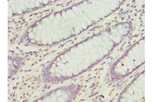 Immunohistochemistry of paraffin-embedded human colon cancer using ABIN7148782 at dilution of 1:100 (CXXC4 抗体  (AA 1-198))