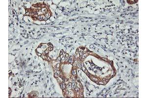 Immunohistochemical staining of paraffin-embedded Carcinoma of Human pancreas tissue using anti-PDSS2 mouse monoclonal antibody. (PDSS2 抗体)