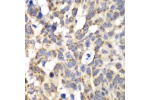 Immunohistochemistry of paraffin-embedded human esophageal cancer using PARN antibody (ABIN6291531) at dilution of 1:100 (40x lens). (PARN 抗体)
