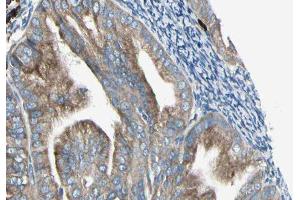 ABIN6279198 at 1/100 staining Human cervical cancer tissue by IHC-P. (BRI3 抗体  (N-Term))
