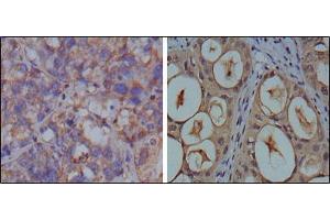 Immunohistochemical analysis of paraffin-embedded human breast carcinoma (left) and kidney carcinoma (right), showing cytoplasmic localization using GAPDH mouse mAb with DAB staining. (GAPDH 抗体)