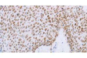 Immunohistochemistry of paraffin-embedded Human lung cancer tissue using MCM2 Polyclonal Antibody at dilution 1:50 (MCM2 抗体)