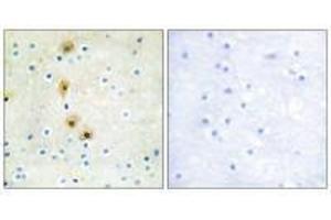 Immunohistochemistry analysis of paraffin-embedded human breast carcinoma tissue using Akt (Ab-326) antibody. (AKT1 抗体  (Tyr326))