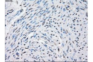 Immunohistochemical staining of paraffin-embedded Carcinoma of thyroid tissue using anti-STAT1 mouse monoclonal antibody. (STAT1 抗体)
