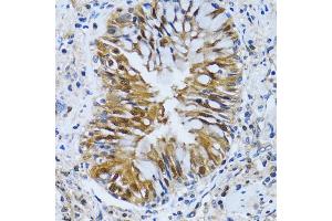 Immunohistochemistry of paraffin-embedded human lung cancer using IMPA1 antibody (ABIN2563424) at dilution of 1:100 (40x lens). (IMPA1 抗体)