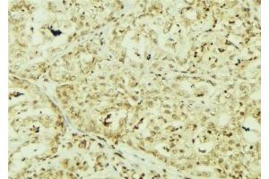 ABIN6267153 at 1/100 staining Human breast cancer tissue by IHC-P. (TCP1 alpha/CCTA 抗体  (pSer160, pSer162))