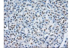 Immunohistochemical staining of paraffin-embedded Adenocarcinoma of Human colon tissue using anti-TACC3 mouse monoclonal antibody. (TACC3 抗体)
