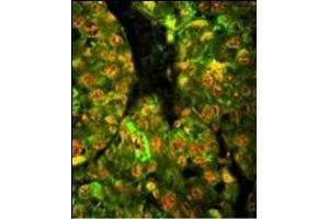 Immunofluorescence analysis of CD38 Antibody (C-term) with paraffin-embedded human hepatocarcinoma tissue. (CD38 抗体  (C-Term))
