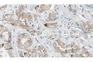 ABIN6279343 at 1/100 staining Human prostate tissue by IHC-P. (NT5C2 抗体)