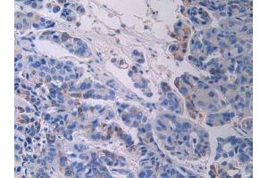 IHC-P analysis of Human Breast Cancer Tissue, with DAB staining. (FGFR3 抗体  (AA 166-375))