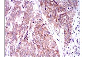 Immunohistochemical analysis of paraffin-embedded bladder cancer tissues using MARK3 mouse mAb with DAB staining. (MARK3 抗体  (AA 435-658))