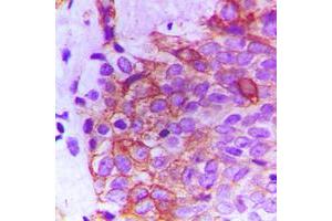 Immunohistochemical analysis of FGFR2 staining in human breast cancer formalin fixed paraffin embedded tissue section. (FGFR2 抗体  (Center))
