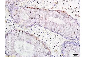 Formalin-fixed and paraffin embedded human colitis tissue labeled with Anti-TNF-alpha Polyclonal Antibody, Unconjugated (ABIN724565) 1:300 followed by conjugation to the secondary antibody and DAB staining (TNF alpha 抗体  (AA 86-150))