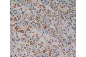 IHC-P analysis of lung cancer tissue, with DAB staining. (Paxillin 抗体  (AA 201-461))