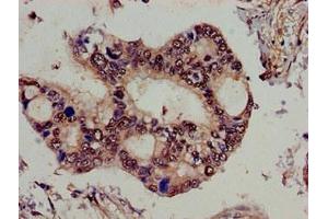 Immunohistochemistry of paraffin-embedded human pancreatic cancer using ABIN7159025 at dilution of 1:100 (SPG21 抗体  (AA 1-308))