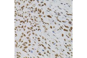 Immunohistochemistry of paraffin-embedded human lung cancer using AKAP8 antibody (ABIN5975842) (40x lens). (AKAP8 抗体)