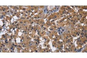 Immunohistochemistry of paraffin-embedded Human thyroid cancer using CD160 Polyclonal Antibody at dilution of 1:30 (CD160 抗体)